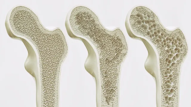 Excessive Coffee Linked to Weaker Bones in Older Women, Tea Shows Modest Benefit