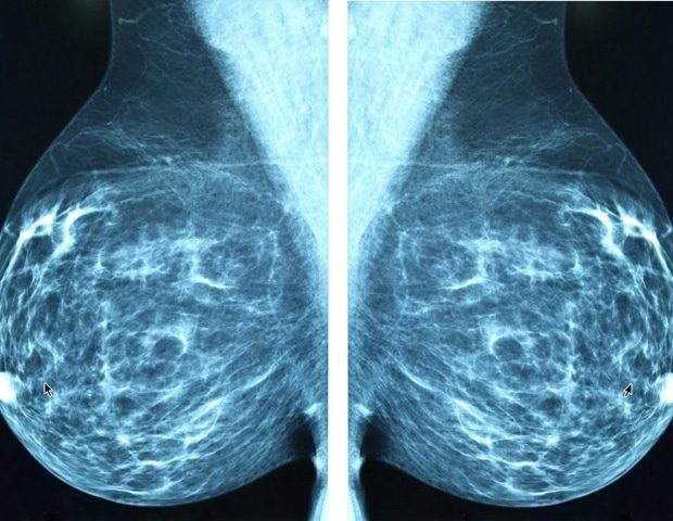 Global Breast Cancer Risk: 1 in 18 Lifetime Diagnosis, Stark Inequalities Revealed