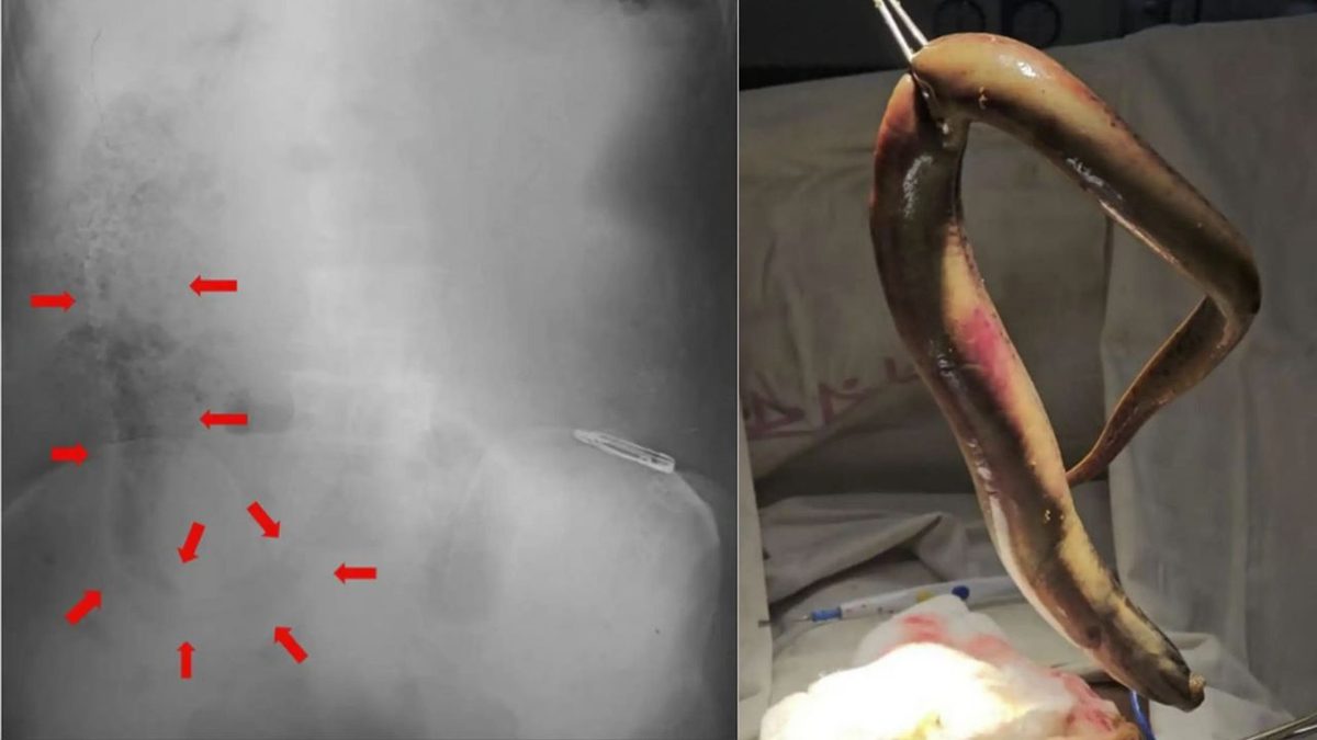 Live Eel Perforates Man's Colon in Extremely Rare Rectal Insertion Case