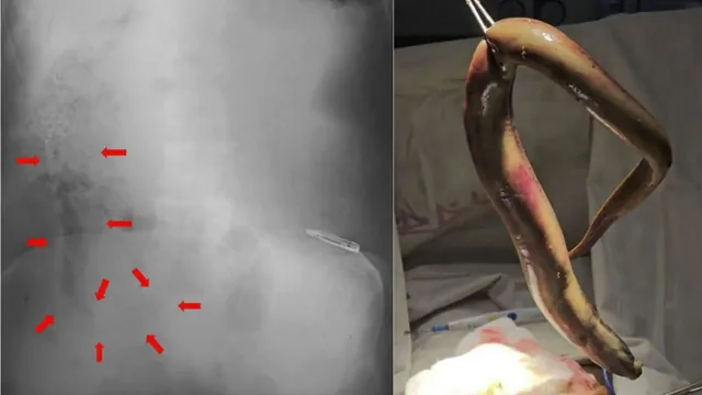 Live Eel Perforates Man's Colon in Extremely Rare Rectal Insertion Case