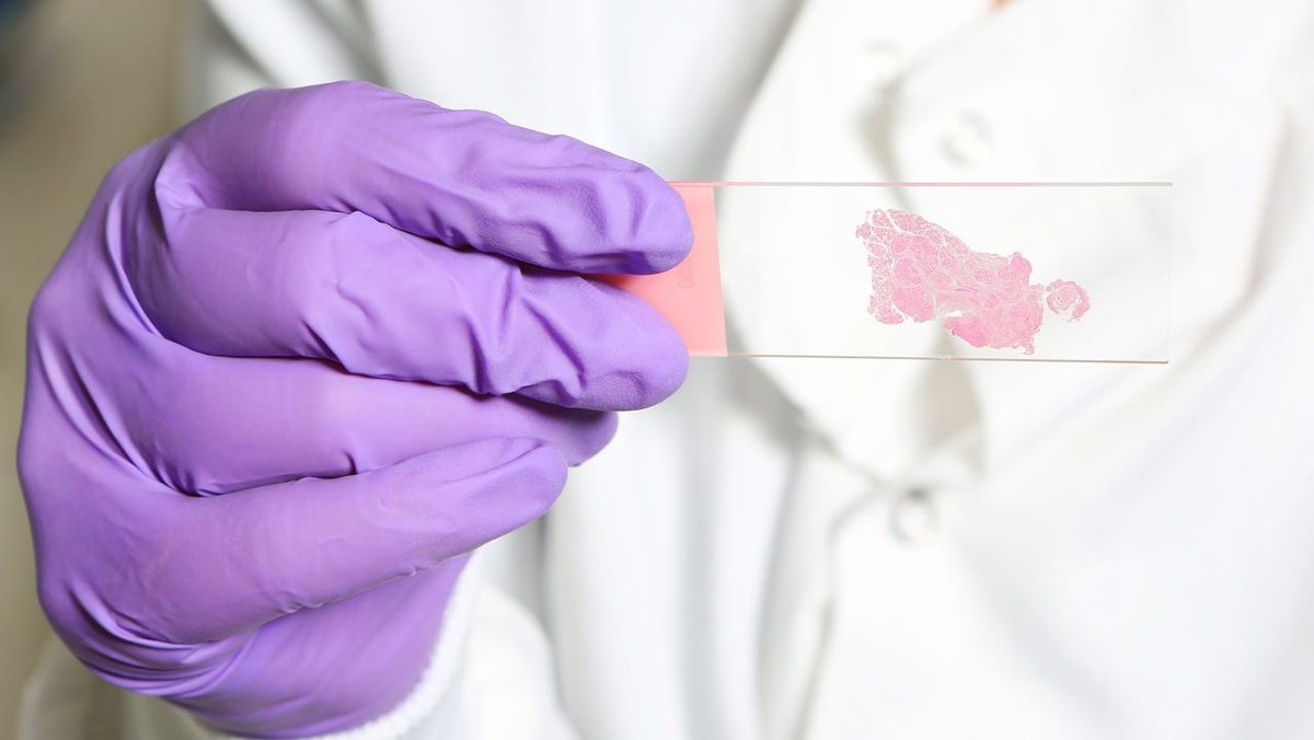 AI Mimics Pathologists' 'Search and Rescue' Approach, Boosting Cancer Detection Accuracy by 100%