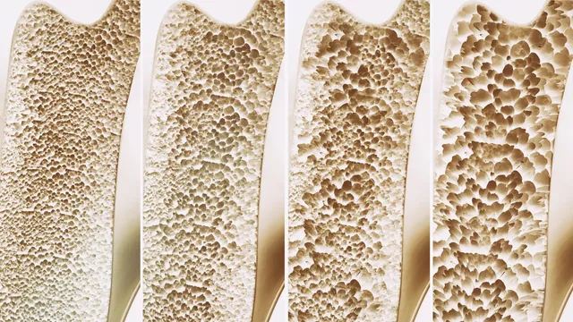 Leipzig Scientists Discover Bone-Building Switch, AP503, Offering Hope Against Osteoporosis