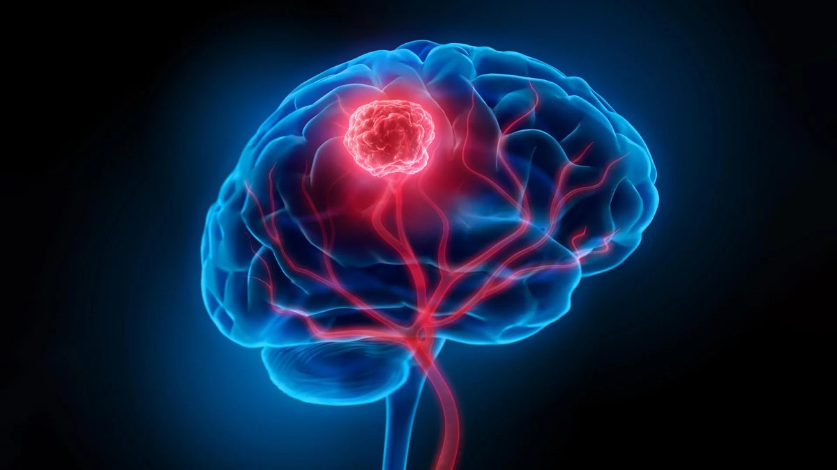 New Nanoparticles Illuminate and Destroy Hidden Brain Cancer in Mice, Offering Hope for Glioblastoma Patients
